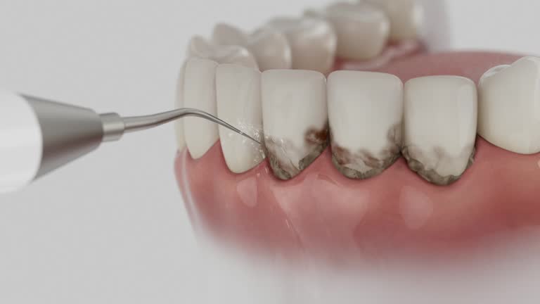 Reliable Wisdom Tooth Removal contractor in Corrigan, TX by Smile Center Dentistry